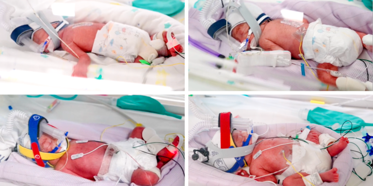 Identical quadruplet girls born